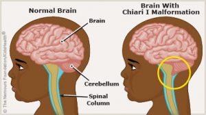 Why does my head hurt when i cough? a quick self diagnosis